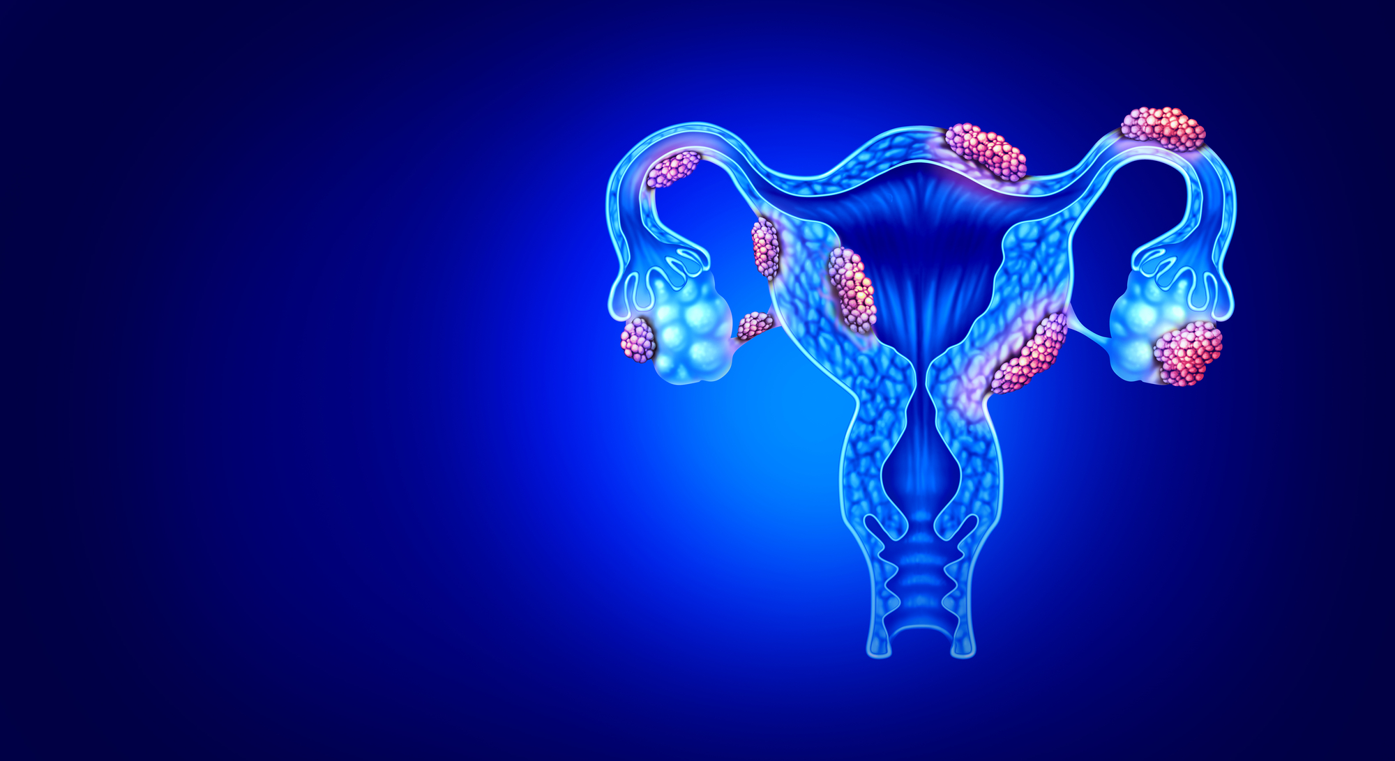 Endometriose verstehen